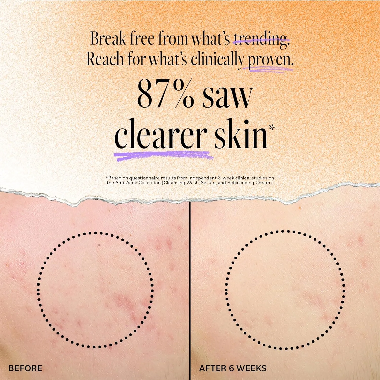 Derma E Acne Deep Pore Cleansing Wash – Blemish Control Facial Cleanser with Salicylic Acid - Gentle Oil Control Face Wash Soothes and Balances Skin, 6 fl oz